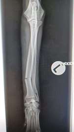 Fixateur extern - wie geht man damit um?-Beitrag-Bild