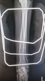 Fixateur extern - wie geht man damit um?-Beitrag-Bild