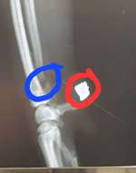 Unverheilter Bruch, schmerzfrei, hatte das schonmal wer?-Beitrag-Bild