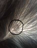 Hautkrebs oder Muttermal?-Beitrag-Bild