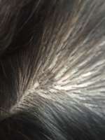 Hautkrebs oder Muttermal?-Beitrag-Bild