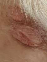 Hautausschlag Ekzem ?-Beitrag-Bild