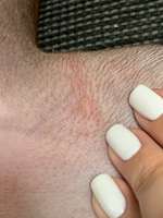 Pickel/Pusteln am Körper-Beitrag-Bild