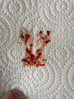 Blut im Kot-Beitrag-Bild