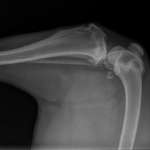 Knochenhautentzündung-Beitrag-Bild