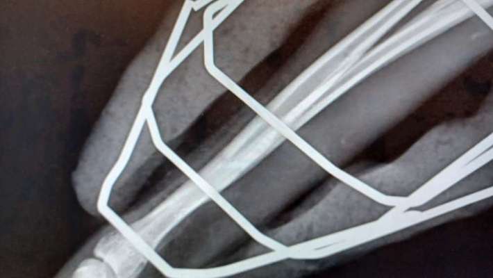 Fixateur extern - wie geht man damit um?-Beitrag-Bild