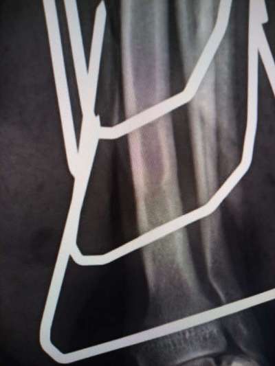 Fixateur extern - wie geht man damit um?-Beitrag-Bild