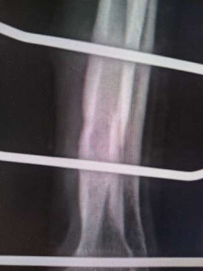 Fixateur extern - wie geht man damit um?-Beitrag-Bild