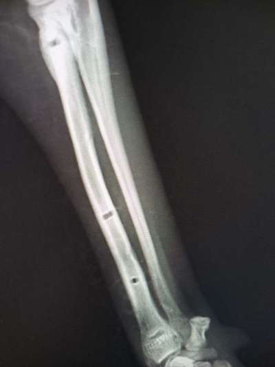 Fixateur extern - wie geht man damit um?-Beitrag-Bild