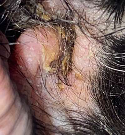 Sebadenitis-Beitrag-Bild