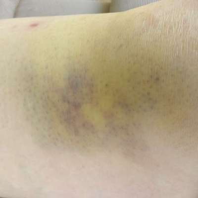 Welche Verletzungen habt ihr durch euren Hund erlitten?-Beitrag-Bild