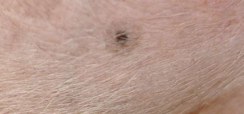 Auffälliges Muttermal-Beitrag-Bild