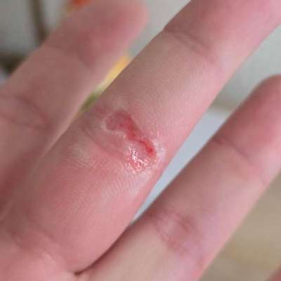 Welche Verletzungen habt ihr durch euren Hund erlitten?-Beitrag-Bild