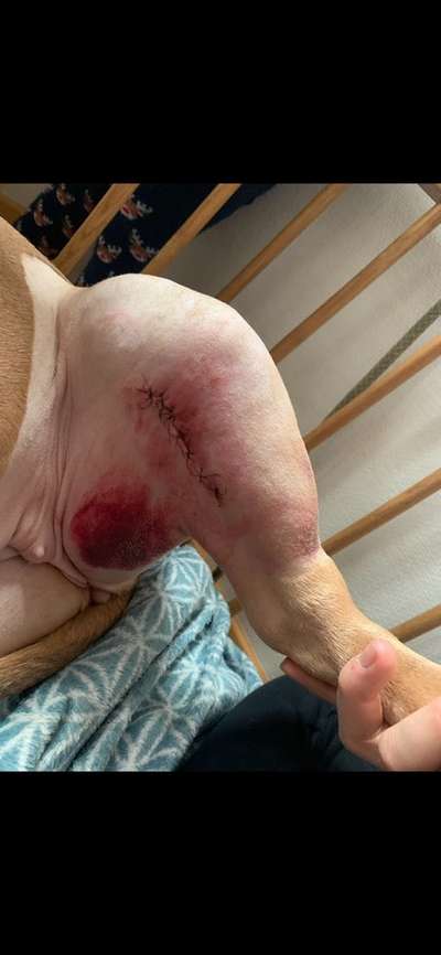 OP Naht Hämatome-Beitrag-Bild