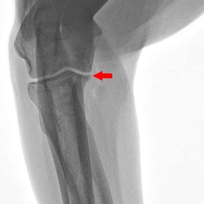 Arthrose im Ellenbogen?-Beitrag-Bild