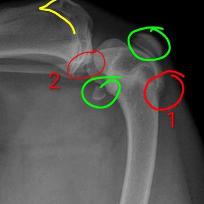 Knochenhautentzündung-Beitrag-Bild