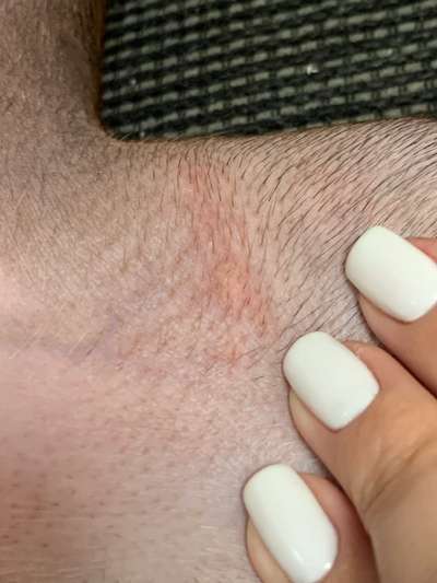 Pickel/Pusteln am Körper-Beitrag-Bild