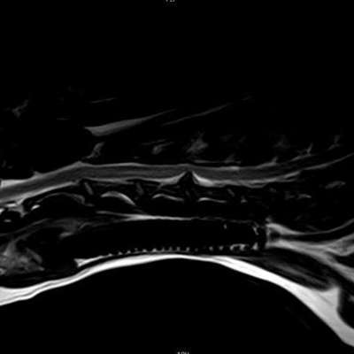 Starke Schmerzen nach dem Spazierengehen / Bandscheibenvorfall-Beitrag-Bild