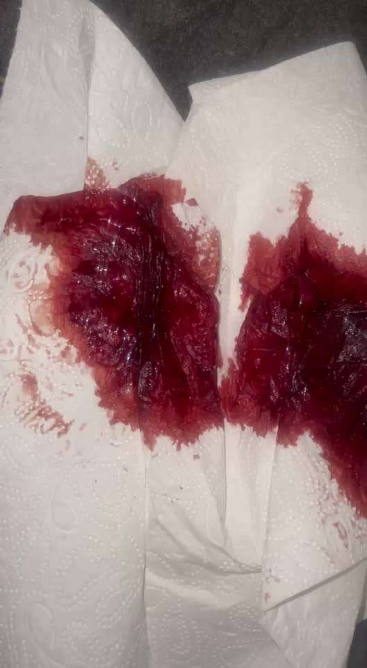 Blutungen..-Beitrag-Bild