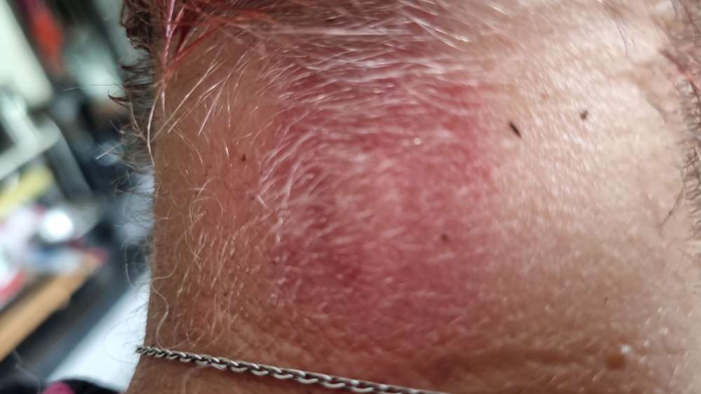 Giftköder-Erdwespen-Profilbild